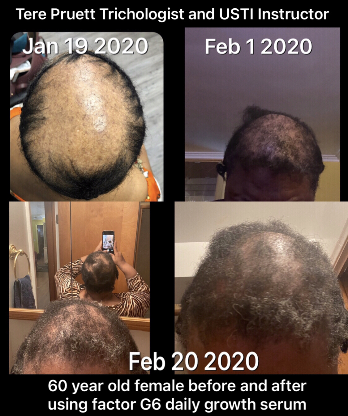 Hair Restoration Merritt Island FL | Hair Loss Treatment Merritt Island | Hair  Loss Therapy Merritt Island | Tere Pruett Trichologist